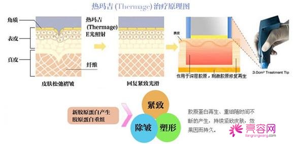 第三代热玛吉果好吗?与第一代有什么区别?