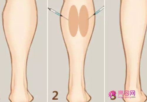 注射瘦腿会反弹吗？术后注意事项有哪些？做者必看