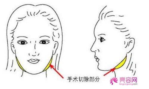 肥胖下颌角整形该如何做？有同样问题的姐妹看过来！