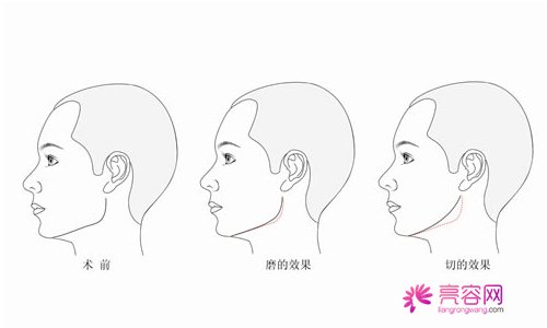 肥胖下颌角整形该如何做？有同样问题的姐妹看过来！