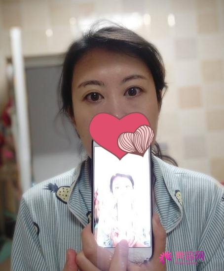 济南芭莎美恩做祛眼袋好不好？医生_案例_价格