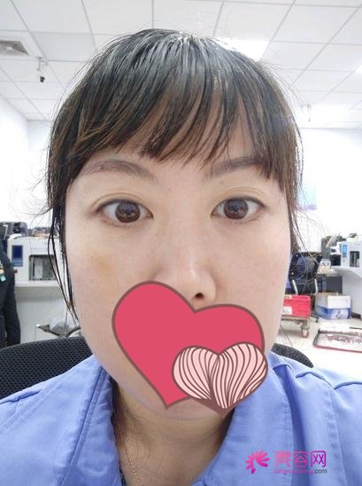济南芭莎美恩做祛眼袋好不好？医生_案例_价格