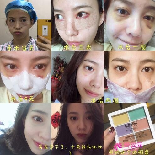 惠州凤凰整形美容医院技术怎么样？在惠州做整形的务必看完