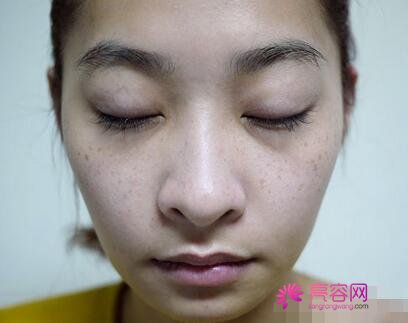 带头风范祛斑果怎么样？内附祛斑手术案例介绍