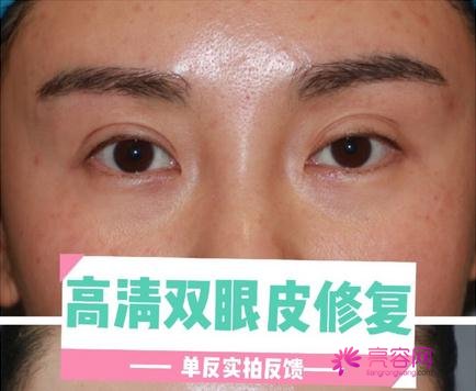 北京埋线双眼皮修复好吗?内附小姐妹北京的双眼皮修复案例对比