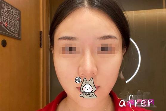 飞顿光子嫩肤果怎么样？来看看真实的手术记录吧