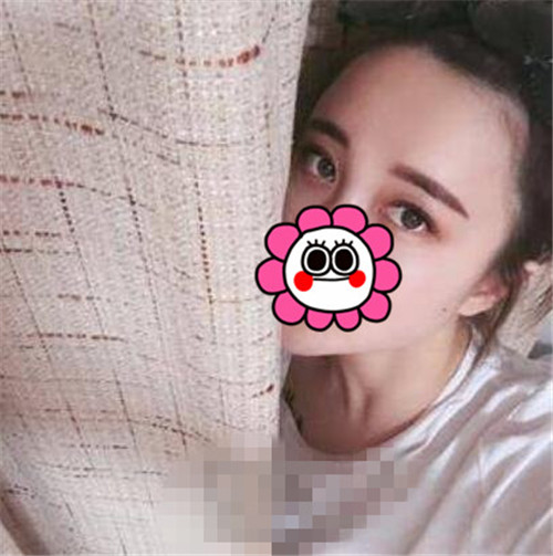 上海华美王荣锡抽脂怎么样?案例,价格