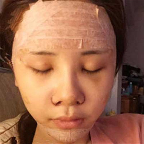 上海华美叶丽萍自体脂肪移植怎么样?案例,价格