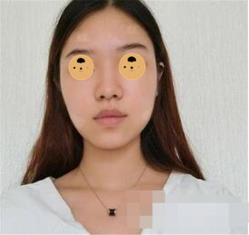 上海华美何斌抽脂怎么样?案例,价格
