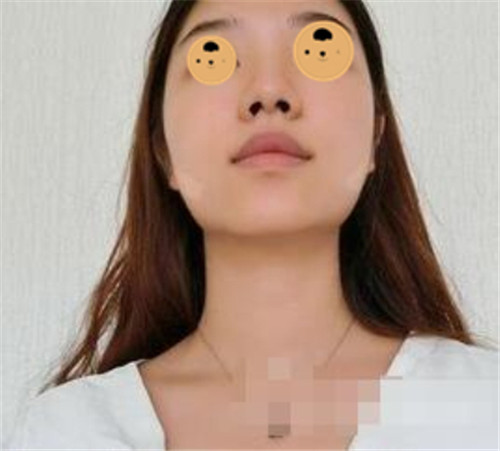 上海华美何斌抽脂怎么样?案例,价格