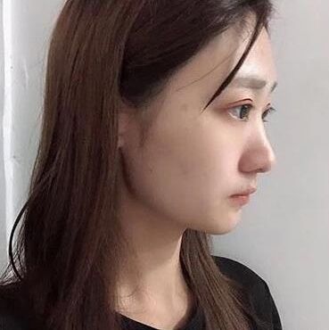 北京煤炭总医院割双眼皮怎么样?案例,价格