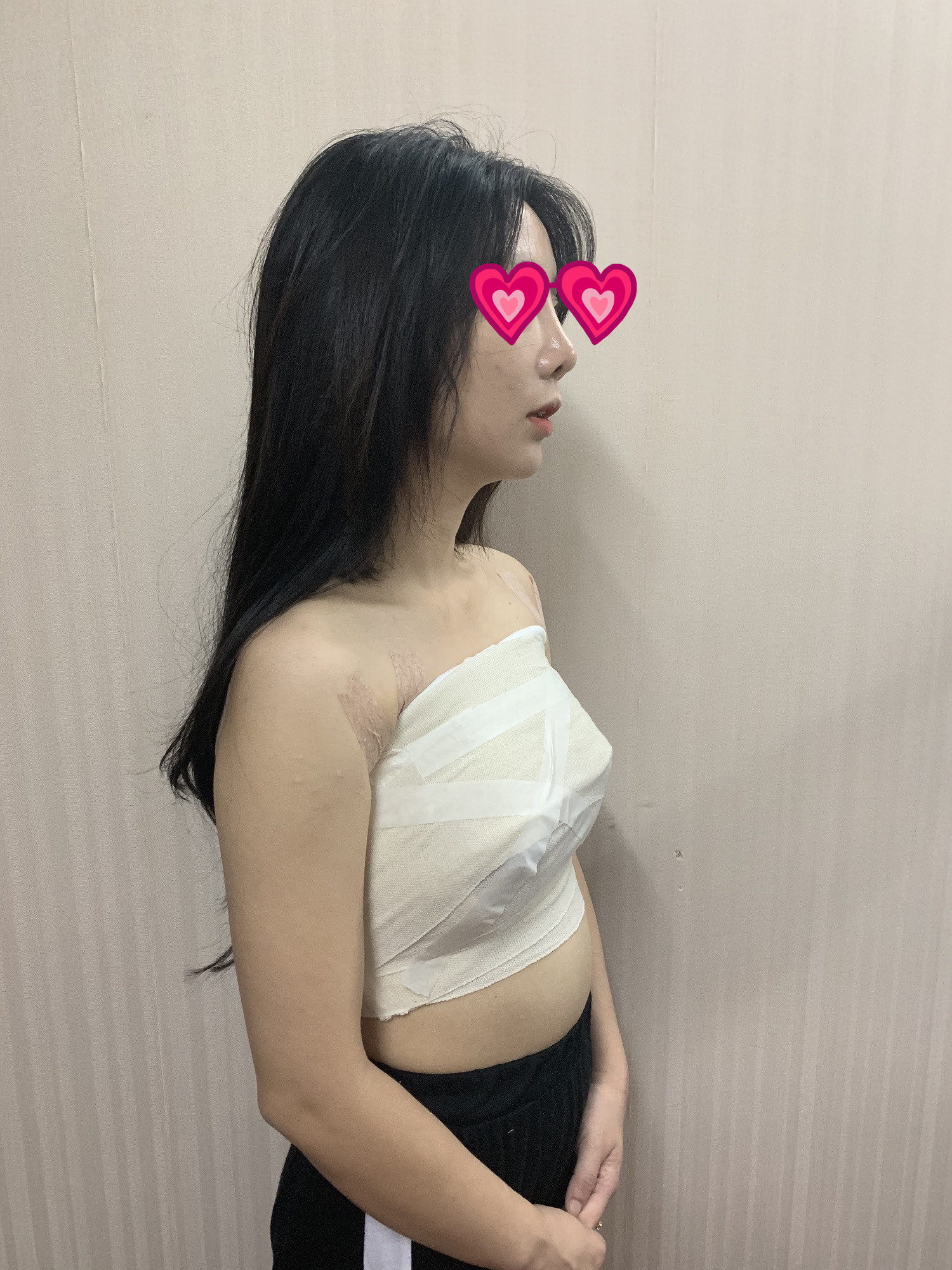 北京知音李奇军隆胸怎么样?案例,价格
