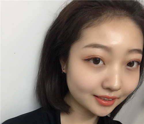 北京京民郭建玲割双眼皮怎么样?案例,价格