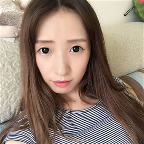 候怡割双眼皮怎么样?案例_价格