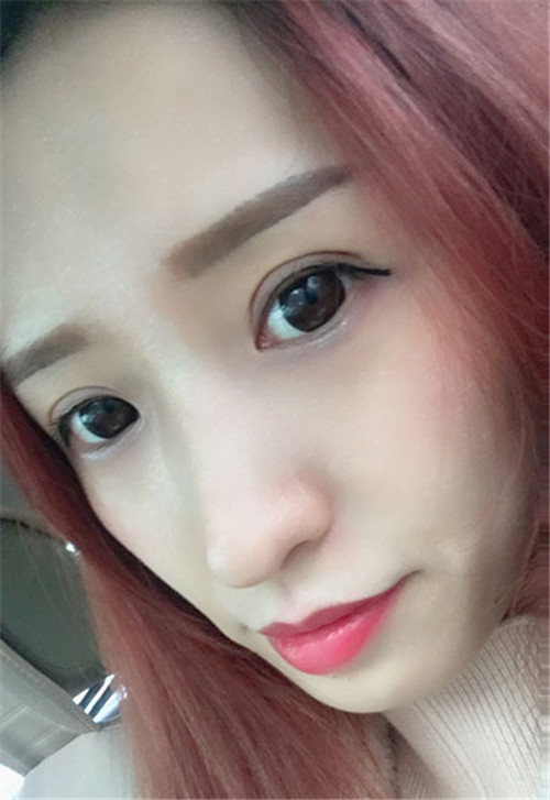 候怡割双眼皮怎么样?案例_价格
