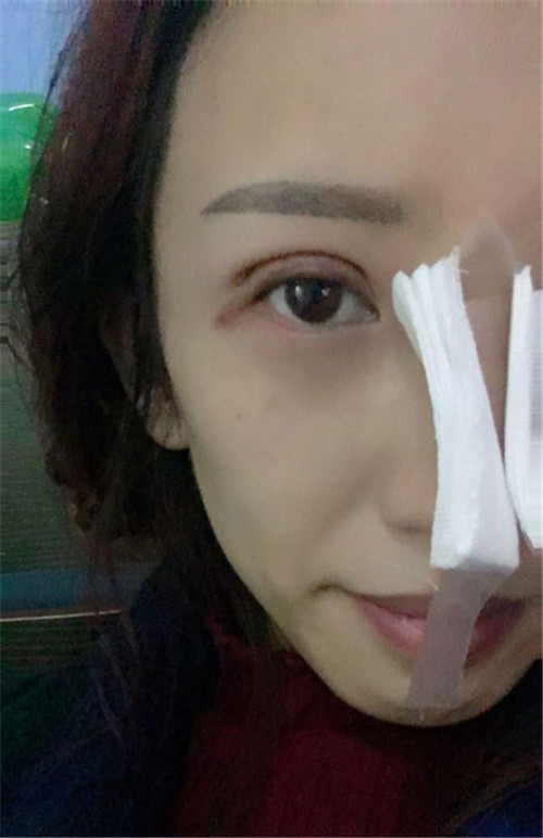 候怡割双眼皮怎么样?案例_价格