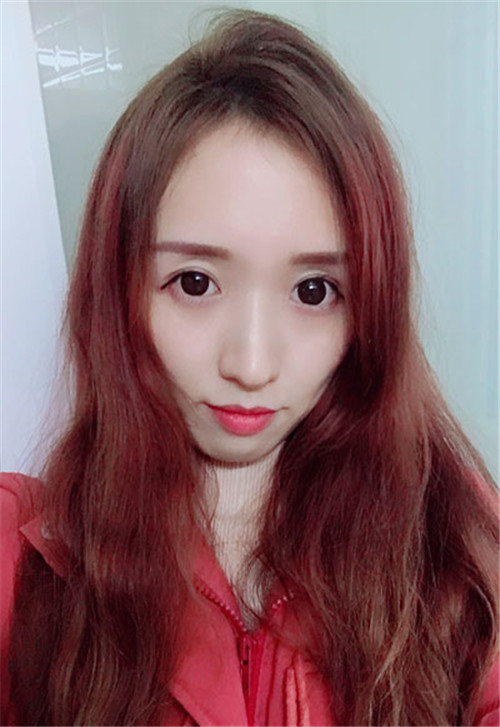 候怡割双眼皮怎么样?案例_价格