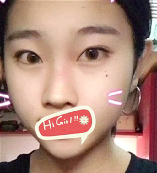 北京克莱美舍割双眼皮怎么样?案例,价格