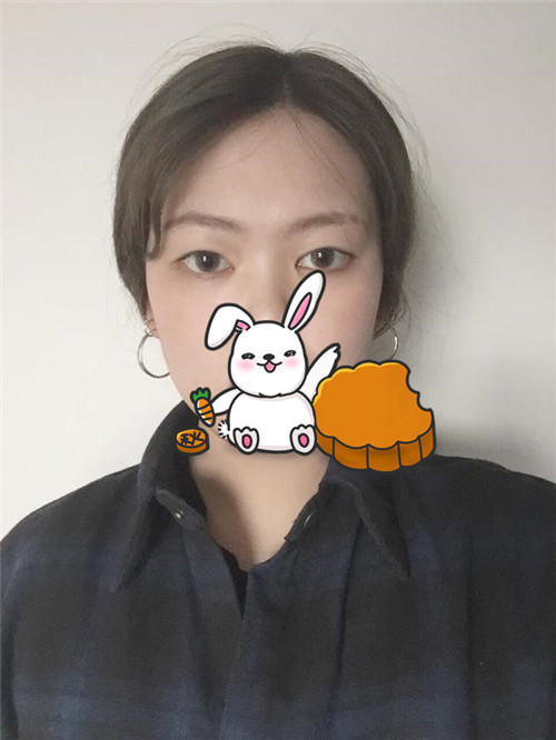 上海容妍柴云割双眼皮怎么样?案例,价格