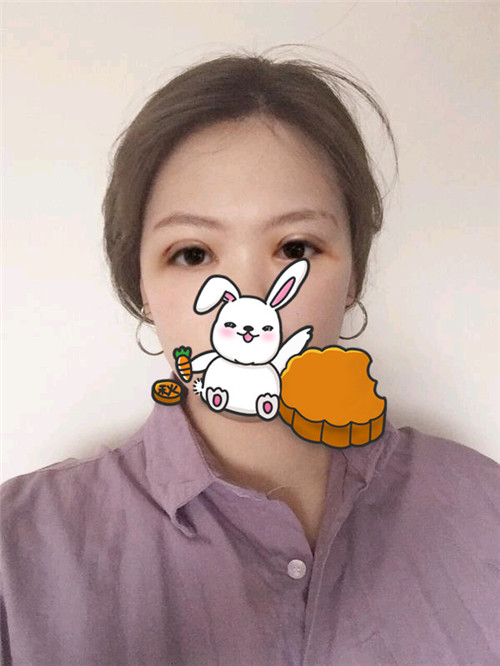 上海容妍柴云割双眼皮怎么样?案例,价格