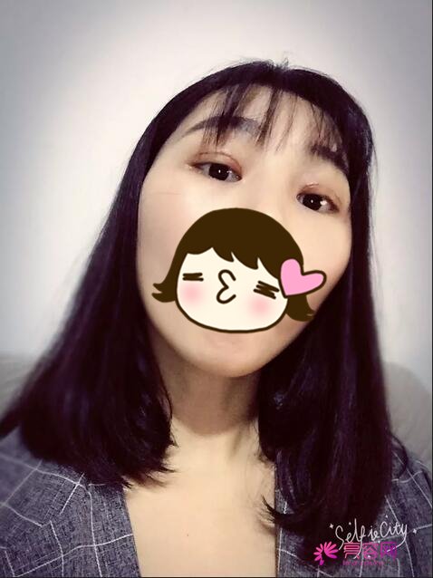 齐齐哈尔君悦鲁姗做双眼皮怎么样?案例,价格,口碑