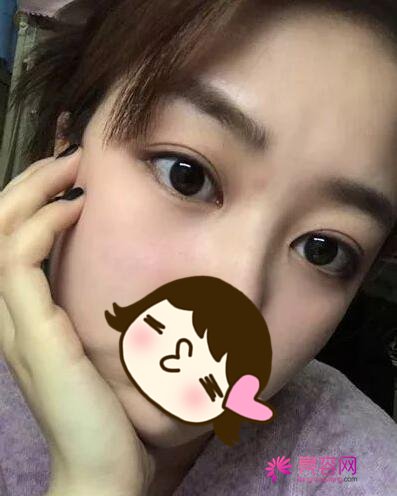 北京伊美尔秦宏伟做双眼皮手术怎么样？案例,价格,口碑