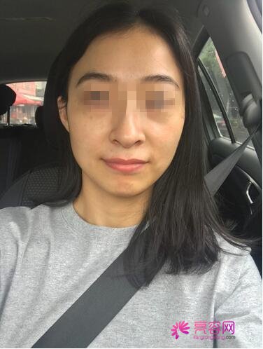 呼伦贝尔刘新娟激光祛斑怎么样?案例,价格,口碑
