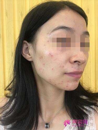 呼伦贝尔刘新娟激光祛斑怎么样?案例,价格,口碑