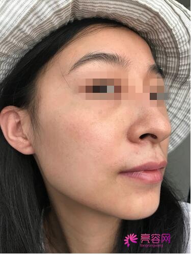 呼伦贝尔刘新娟激光祛斑怎么样?案例,价格,口碑