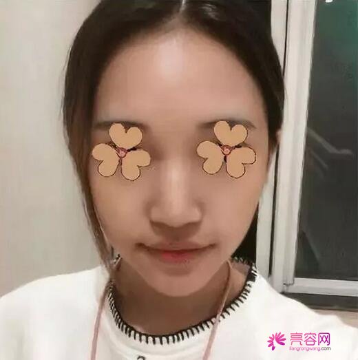 三亚韩氏丛国辉隆鼻怎么样?案例,价格,口碑