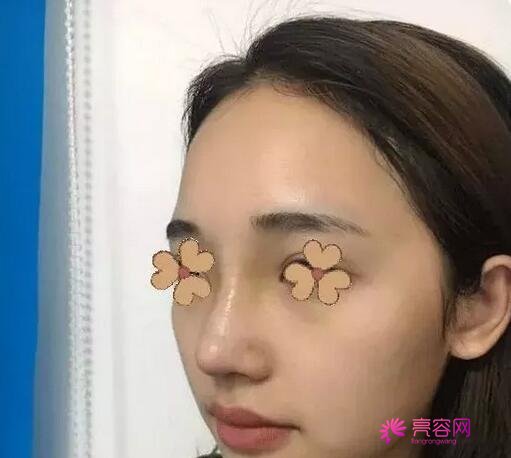三亚韩氏丛国辉隆鼻怎么样?案例,价格,口碑