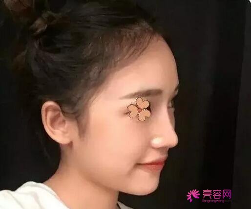三亚韩氏丛国辉隆鼻怎么样?案例,价格,口碑