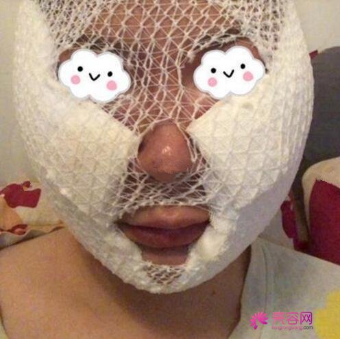 上海臻妮沈莺莺做的下颌角整形怎么样?案例,价格,口碑
