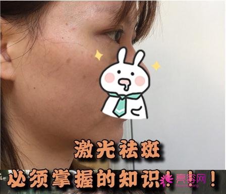 唐山苏亚美联臣金日炫做激光祛斑怎么样？案例_价格_口碑