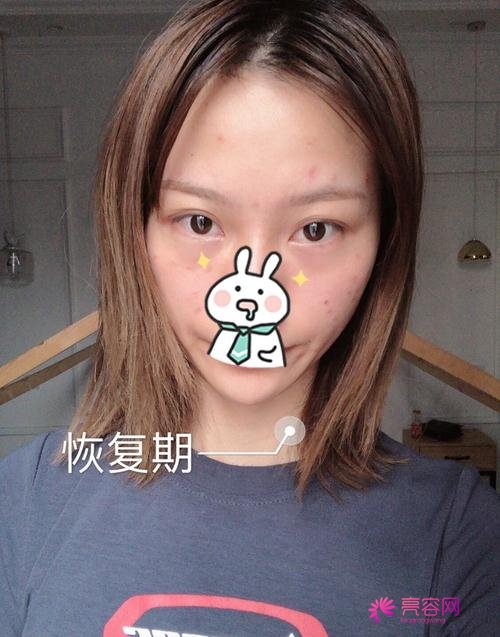 唐山苏亚美联臣金日炫做激光祛斑怎么样？案例_价格_口碑