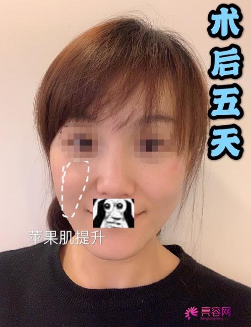嘉兴曙光金瑶做热玛吉怎么样？案例_价格_口碑