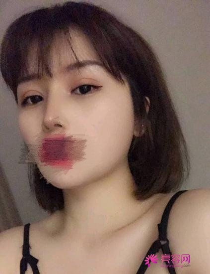 北京长虹赵宏伟隆鼻技术怎么样?案例_价格_口碑