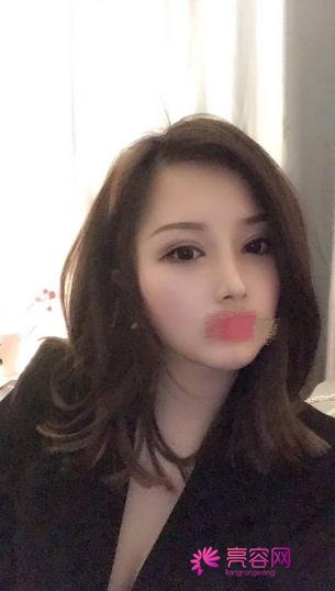 北京长虹赵宏伟隆鼻技术怎么样?案例_价格_口碑