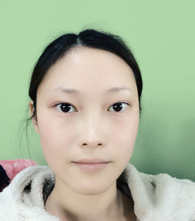 北京联合丽格邢新割双眼皮怎么样?案例,价格