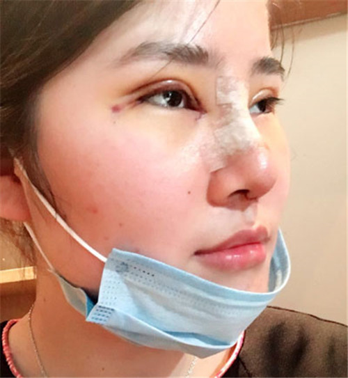 吴海龙割双眼皮怎么样?案例,价格