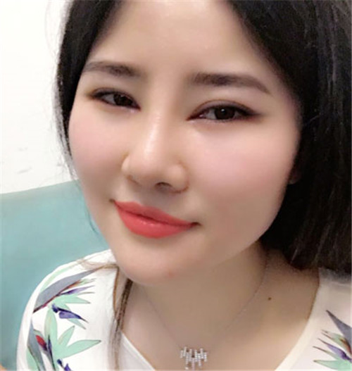 吴海龙割双眼皮怎么样?案例,价格