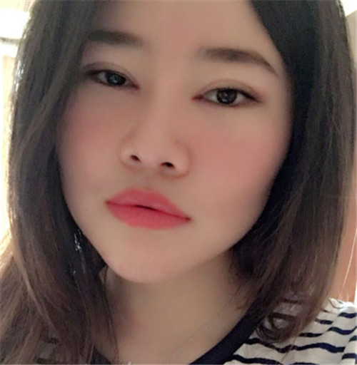 吴海龙割双眼皮怎么样?案例,价格
