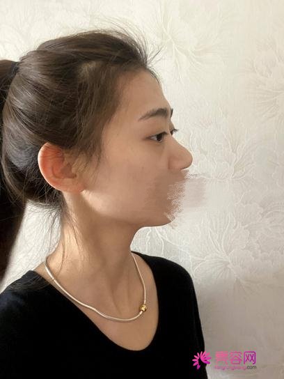 杭州格莱美王洪做综合美鼻怎么样?案例_价格_口碑