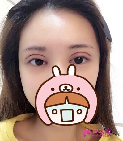 长沙爱思特张姣姣做双眼皮手术果怎么样？案例,价格,口碑