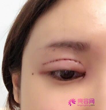长沙爱思特张姣姣做双眼皮手术果怎么样？案例,价格,口碑