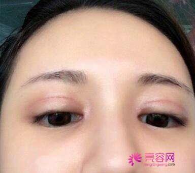 长沙爱思特张姣姣做双眼皮手术果怎么样？案例,价格,口碑