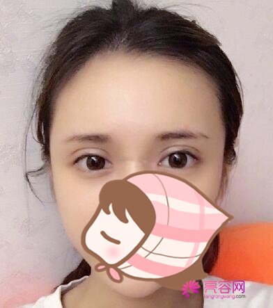 长沙爱思特张姣姣做双眼皮手术果怎么样？案例,价格,口碑
