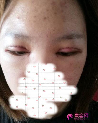 宁波美塑温志刚双眼皮技术怎么样?案例_价格_口碑