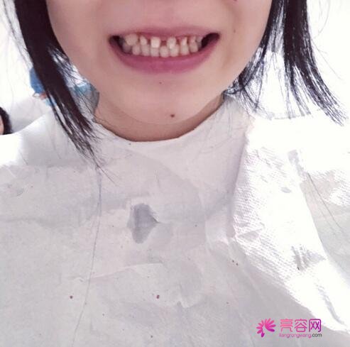 深圳正夫口腔严宁做牙齿种植怎么样?案例_价格_口碑