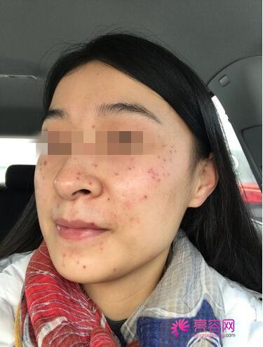 北京臻瑞尚美宋瑜做激光祛斑手术怎么样？案例,价格,口碑